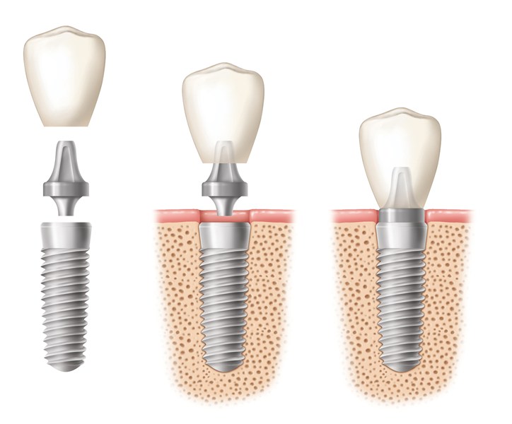 implant-turkey