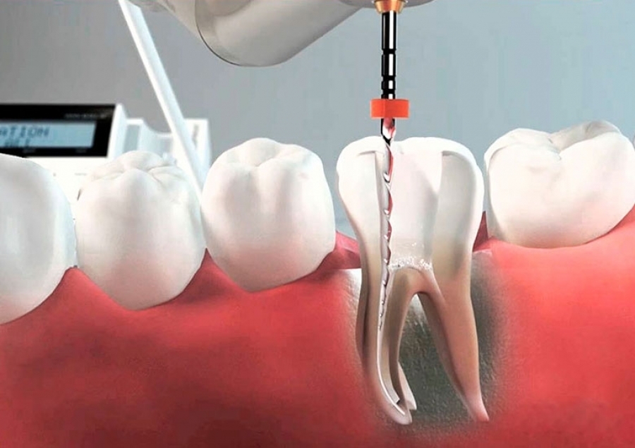 root canal turkey