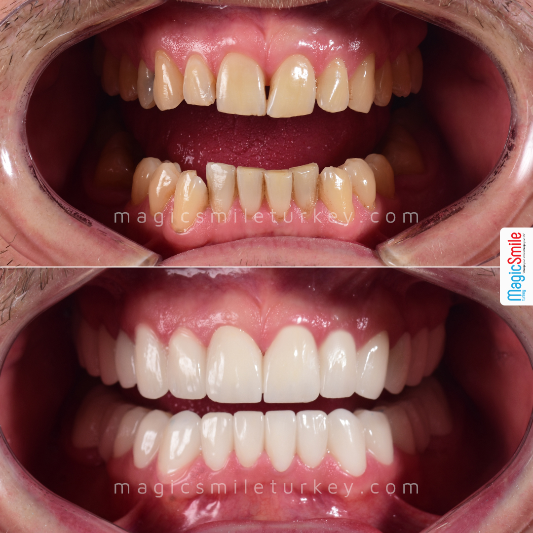 smile makeover before after