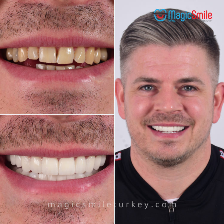 dental implant turkey before after