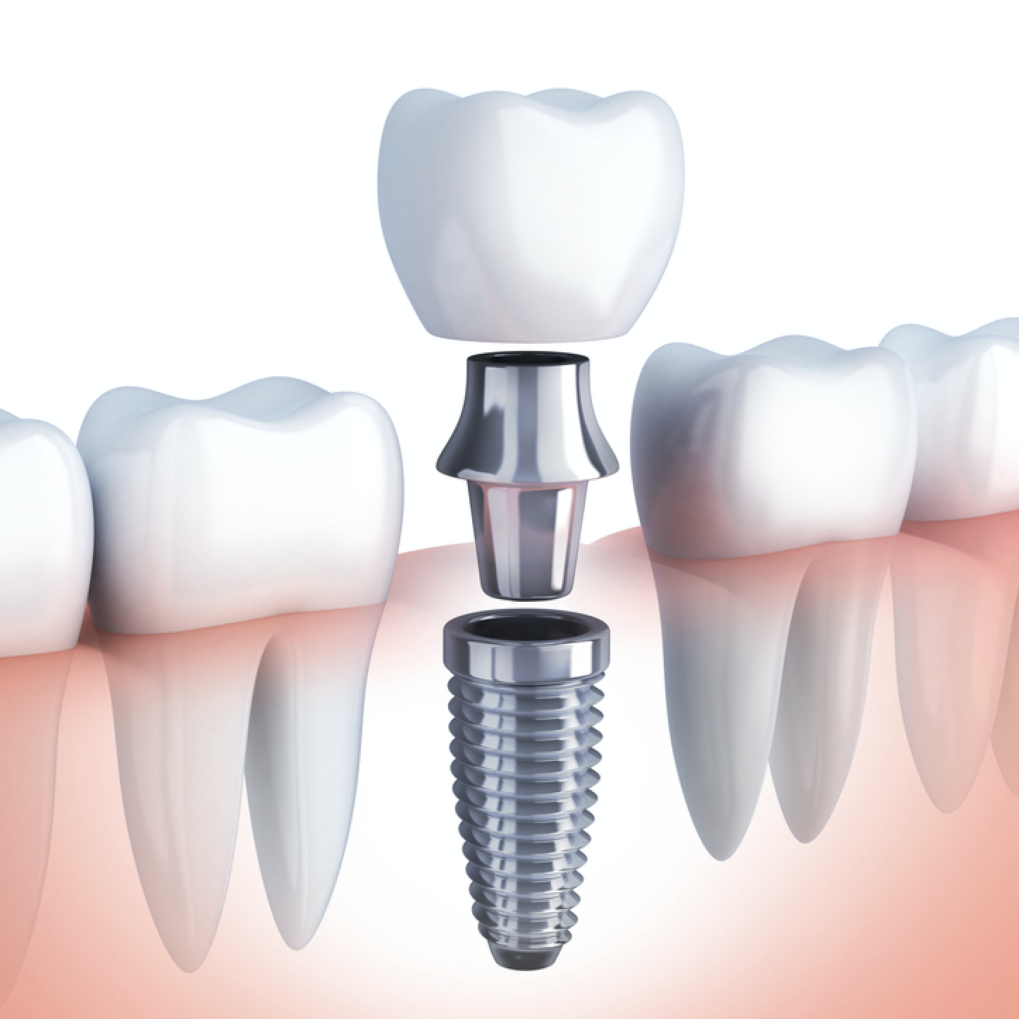 Dental Implant Guide