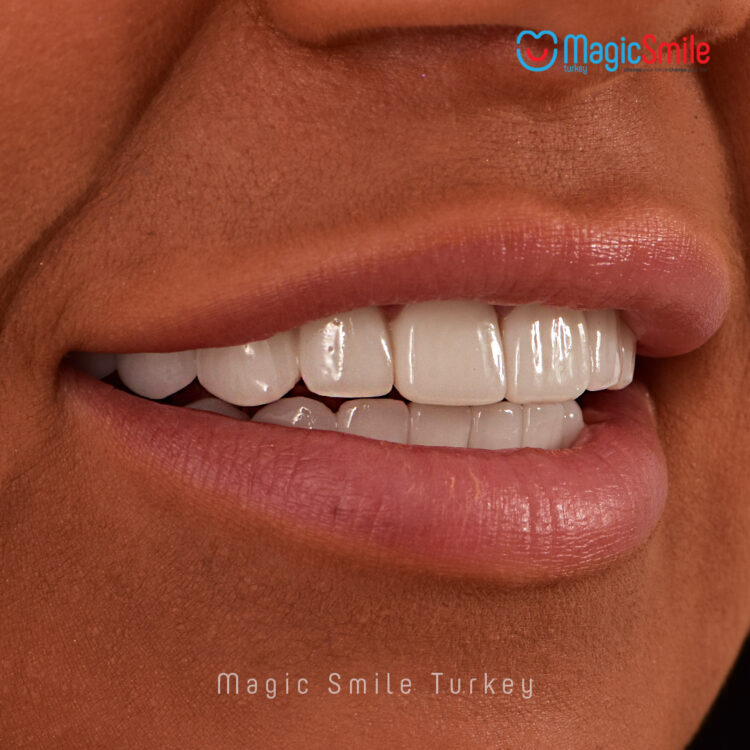 veneers turkey