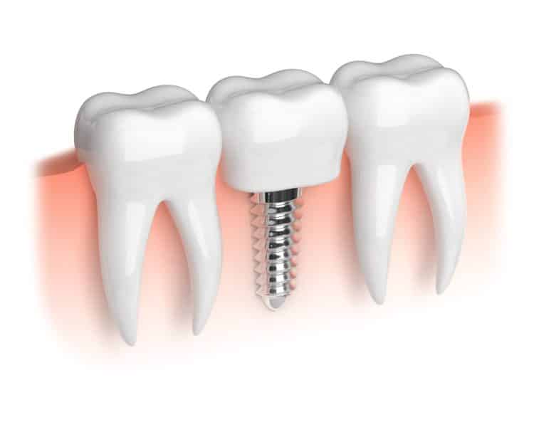 Best-Dental-Implants-Cost-in-Turkey