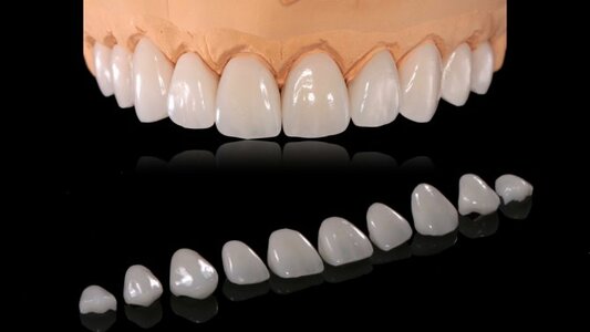 E-Max Laminate Veneers: Your Key to a Flawless Hollywood Smile